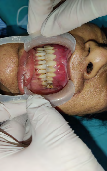 Figure 4: Left Side Pre-Operative Intra-Oral View.