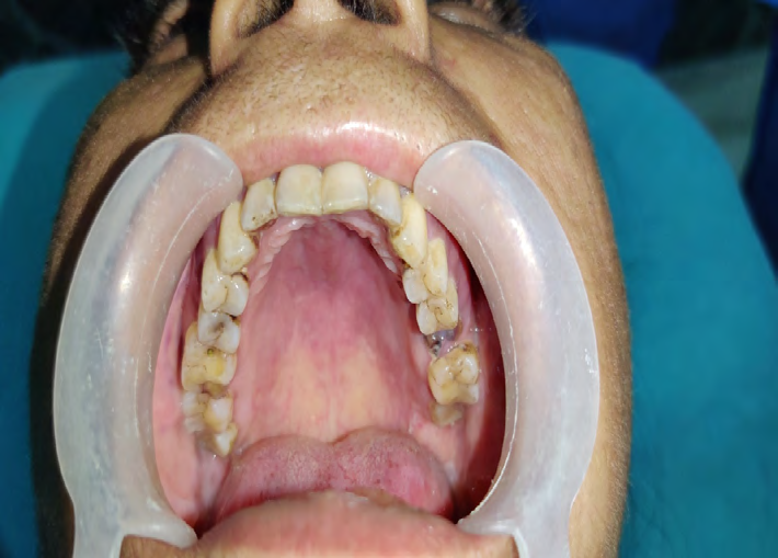 Figure 5: Pre-Operative Palatal View.