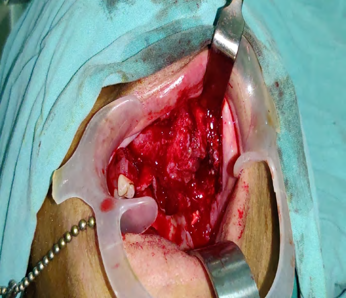 Figure 7: Surgical Debridement.