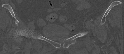 Figure 3: O arm in position.
