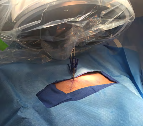 Figure 4: Conventional C arm positioned for trocar placement into rami fractures.