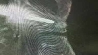 Figure 6: Post calcium phosphate delivery, inlet view of pubic rami.