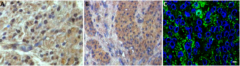 Figure 2: GPER Distribution in Leiomyomas. (A): Typical leiomyoma. (B-C): Fast-growing leiomyomas. A and B: (DABIP). Nuclei have been counterstained with haematoxylin. C: GIF. Nuclei have been counterstained with DAPI. Scale bar: 5µm.