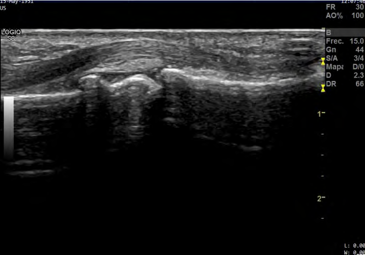 Figure 1: Grey-scale image that shows horse saddle sign in the proximal interphalangeal joint.