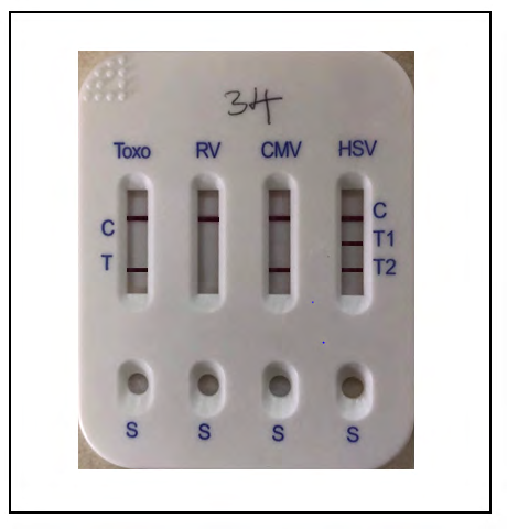 Figure 3: Picture showing a five in one Bio-System Torch Test Panel Kit positive for Toxo, RV and CMV.