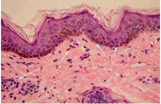 Figure 3: Ephelis exhibiting hyperkeratosis and acanthosis of the superimposed stratified squamous epithelial layer long with melanocytes packed with melanin pigment scattered within the upper dermis [11].