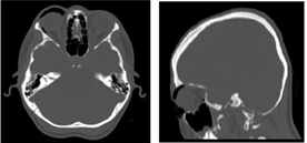 Figure 1: Axial (a) and sagittal (b) CT scan shows evidence of a preseptal and extraconal orbital emphysema.