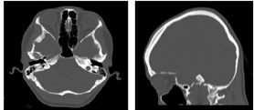 Figure 2: Axial (a) and sagittal (b) CT scan on 3rd month shows full recovery.