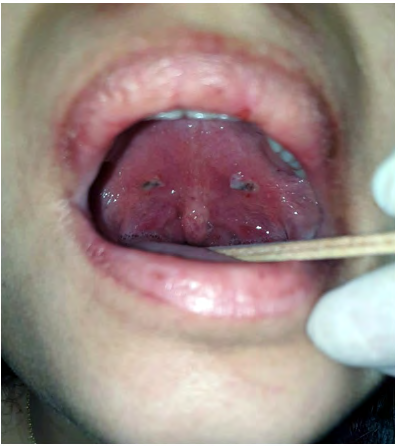Figure 2: Shows bilateral peritonsillar abscess in our case after incision and drainage.