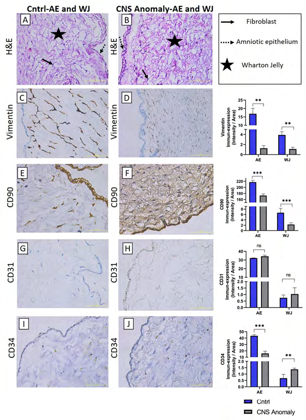 Figure 2: General morphology is seen with hematoxylin-eosin staining in amniotic epithelium and Wharton jelly (A-B). Immun-expressions and density/area significance analyzes (C-D) of vimentin marker between groups in amniotic epithelium and wharton jelly, immuno-expressions of CD90 between groups in amniotic epithelium and wharton jelly, and density/ area significance analysis (E-F), CD31 Immun-expressions and density/area significance analyzes (G-H) between groups in amniotic epithelium and wharton jelly and immuno-expressions and density/area significance analyzes of CD34 between groups in amniotic epithelium and wharton jelly are given (I-J). Scale bar 50µM and microscope magnification 40x.