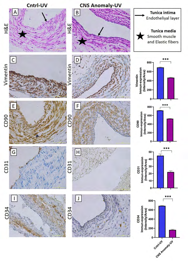 Figure 6: Hematoxylin-eosin staining in the umbilical vein of the control group and fetal cords with CNS anomalies and general morphology (A-B). Immun-expressions of Vimentin between groups in the umbilical vein and density/area significance analysis (C-D), immuno-expressions of CD90 between groups in the umbilical vein and density/area significance analysis (E-F), immune-expressions of CD31 between groups in the umbilical vein. And density/area significance analyzes (G-H) and immuno-expressions of CD34 in the umbilical vein between groups and density/area significance analyzes (I-J). Scale bar 50µM and microscope magnification 40x.