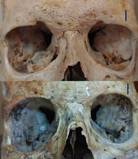 Figure 3: Supranasal Linear Shaped Type (two examples).