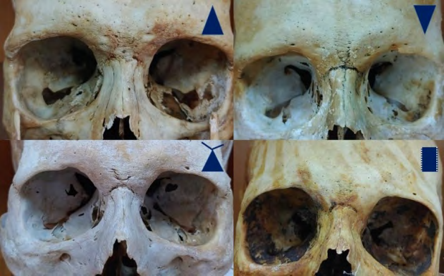 Figure 4: Various types of Supranasal lines. Triangle shaped (upper left side), Triangle shaped with Wings (bottom left side), V-shaped double (upper right side) and Double linear shaped (bottom right side).