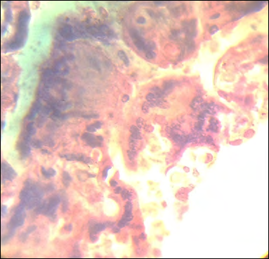 Figure 1: Remains of villi in the intervillous space.H&E.1000x.