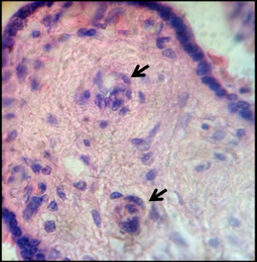 Figure 2: Zone of stem villi [arrows] where has missing the vessels.H&E.1000x.