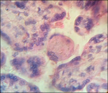 Figure 3: Some placental villi are observed with syncytial regions absent or detached (Figure 4). Large nucleus of cytotrophoblasts cells can to be seen when regions of syncytio have missing (Figure 5). Groups of nucleus of syncytio are noted sticking out of the structure of the placental villi (Figure 6). Syncytials nucleus stick out of the villi and resemble exceed the limits of the syncytial membrane (Figure 7). Debris of villi, syncytials picnotic nucleus more bands of fibrinoid are seen in the intervillous space (Figure 8). Some of these sections of the placental tissue showed that the virocyts [arrows] have been witness of the viral activity (Figure 9).