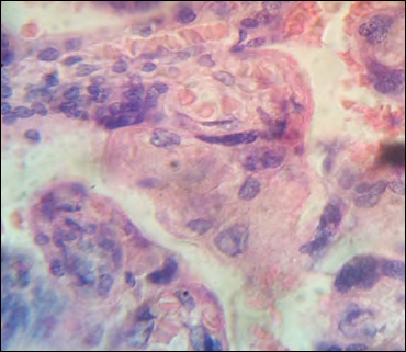 Figure 5: Region without syncytio with large cytotrophoblastics nucleus.H&E.1000x.