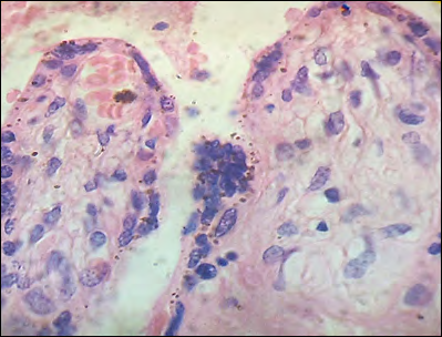 Figure 6: Aggregated syncytials nucleus shedding in the intervillous space.H&E.1000x.