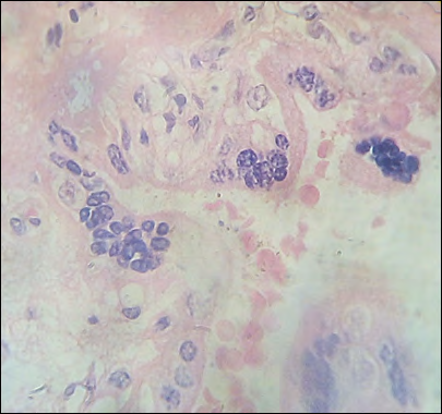 Figure 8: Villous disorganization.H&E.1000x.