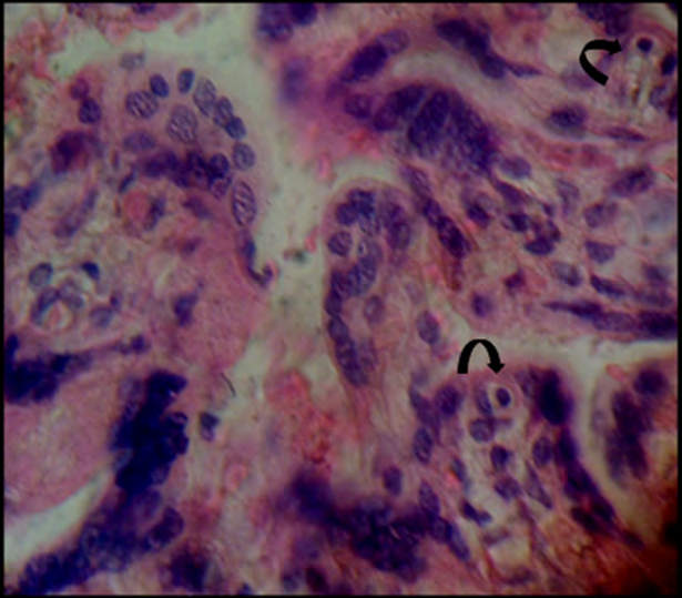 Figure 9: Virocytes [arrows] or cells with form of owl eye.H&E.1000x.