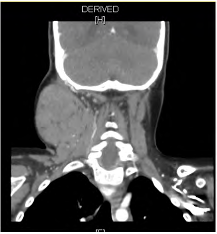 Figure 2: CT scan - Coronal cut demonstrating multiple well-defined masses of different sizes in the right deep cervical chain with central hypodensity suggesting necrotic involvement.