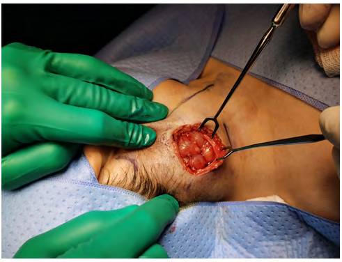 Figure 3: A large number of lymph nodes revealed after subplatysmal dissection.