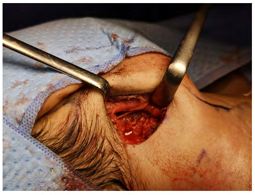 Figure 4: Intraoperative view post lymph node dissection.