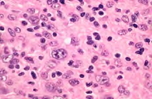 Figure 5: Higher power magnification showing large atypical mononucleated, binucleated Hodgkin Reed- Sternberg (HRS) cells surrounded by mixed inflammatory cells (H&E40X).