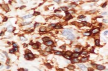 Figure 6: Immunohistochemistry for Leukocyte Common Antigen (LCA) showing negative staining in the large HRS cells while showing positive staining in the surrounding smaller lymphocytes. (40x)