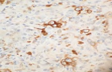 Figure 7: Immunohistochemistry for CD30 showing membranous positivity in HRS cells. (40x)
