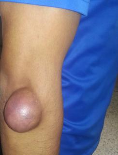 Figure 1: Clinical Aspect of the Hydatid Cyst.