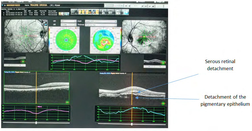 Figure 2: Radial macular OCT image of the patient’s left control eye after the 3 anti-VEGF injections, we note the disappearance of the stalls, a regression of retinal serous detachment with persistence of a fine blade of retinal serous detachment and serous detachment of the retrofoveolar pigmentary epithelium.