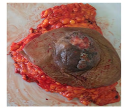 Figure 1: Modified Radical Mastectomy (MRM) specimen of breast showing tumor with skin, areola ulceration.