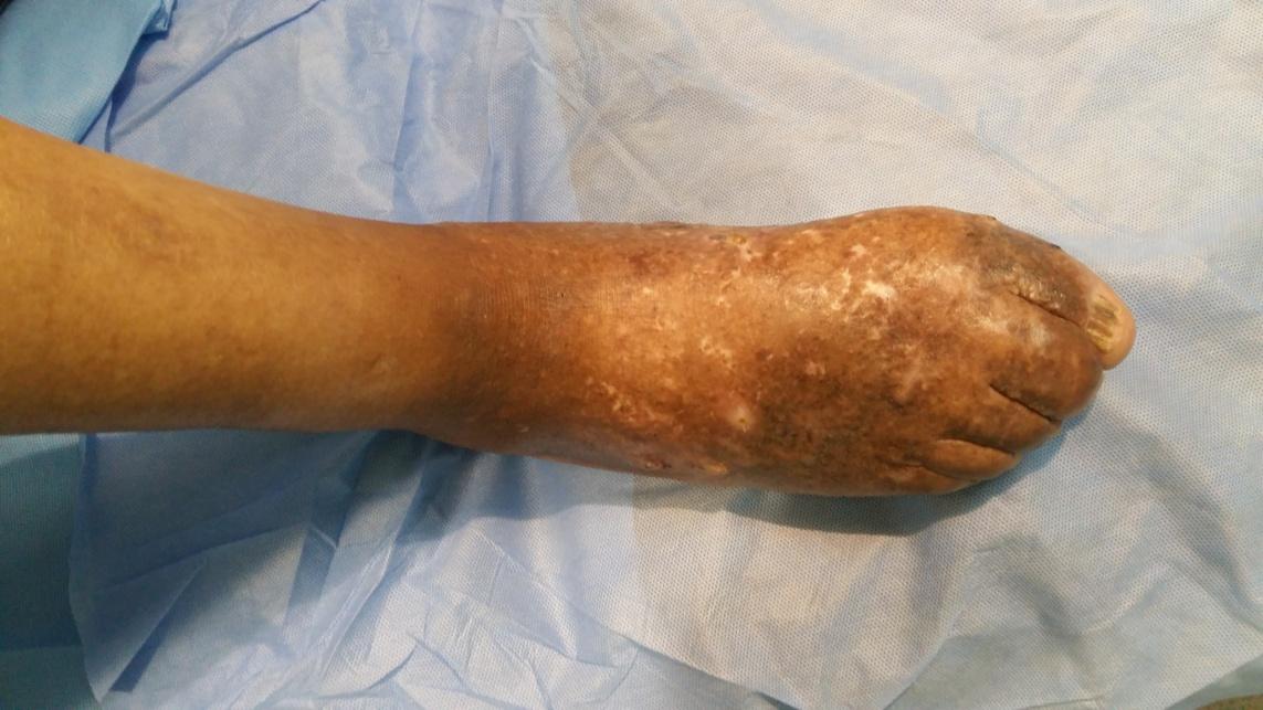Figure 2: Dorsal Aspect of the Right Foot Showing Plaques, Nodules and Fistulas.