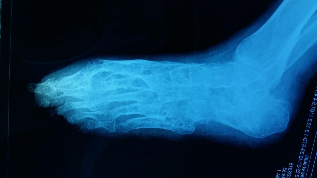 Figure 3: Standard Radiography of the Right Foot Showing Massive Osteolysis