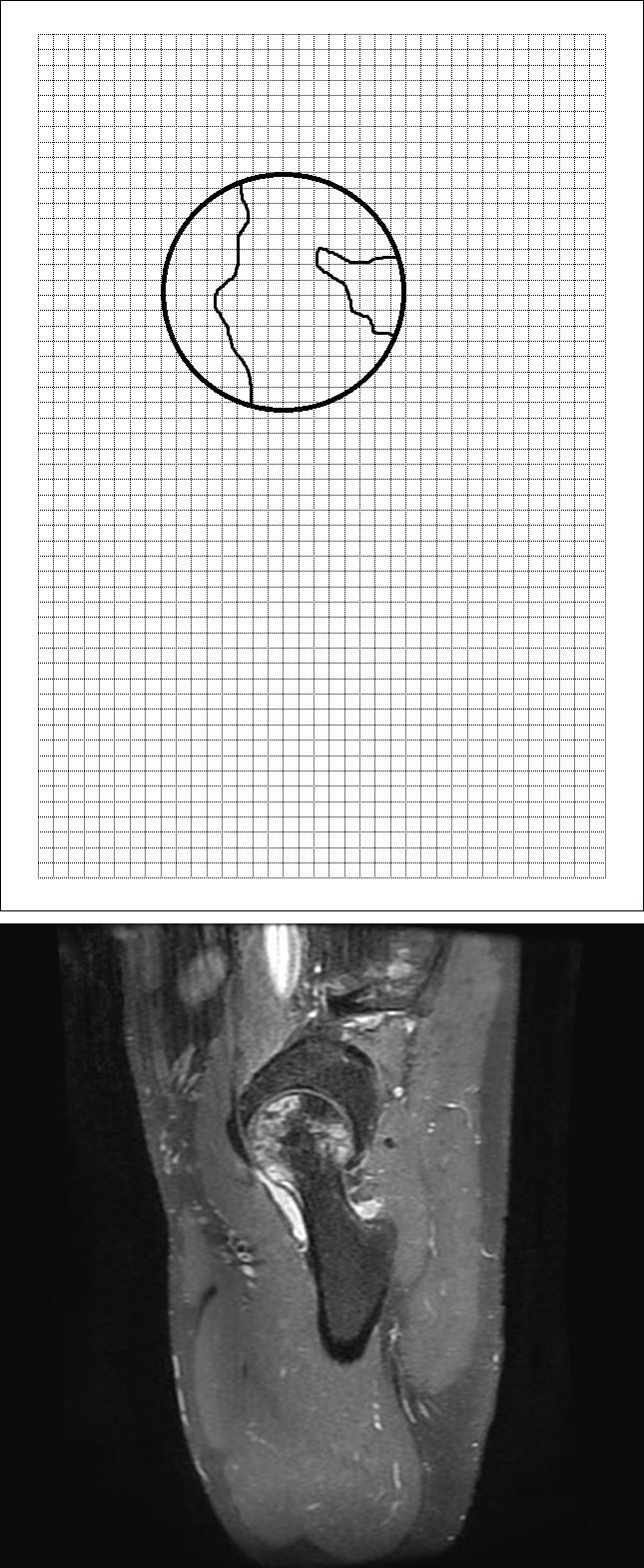 Figure 1: Mid-sagittal section of the femoral head on MRI. The degree of necrosis was calculated on the latticed paper as the percentage of necrotic area to the area of the whole femoral head.