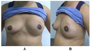 Figure 1: 1-Month post-operative period of Skin-Sparing Left Modified Radical Mastectomy with preservation of the Nipple Areola Complex and immediate reconstruction with retropectoral silicone cohesive gel breast prosthesis. A: Front View, B: Left side view.
