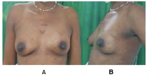 Figure 2: 9-month post-operative period of Skin-Sparing Left Skin-Sparing Left Modified Radical Mastectomy with preservation of the Nipple Areola Complex and immediate reconstruction with retropectoral silicone cohesive gel breast prosthesis. A: Front View, B: Left side view.
