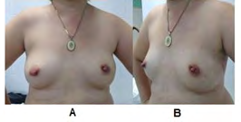 Figure 3: 2-month post-operative period of Skin-Sparing Left Skin-Sparing Left Modified Radical Mastectomy with preservation of the Nipple Areola Complex and immediate reconstruction with retropectoral silicone cohesive gel breast prosthesis. A: Front View, B: Left side view.