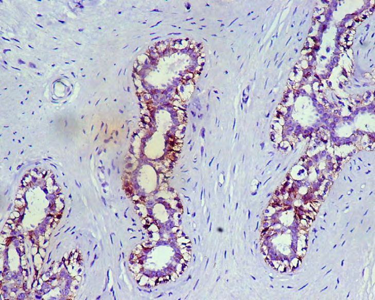 Figure 2: Fibroadenoma- P Cadherin Positive (TS 8).