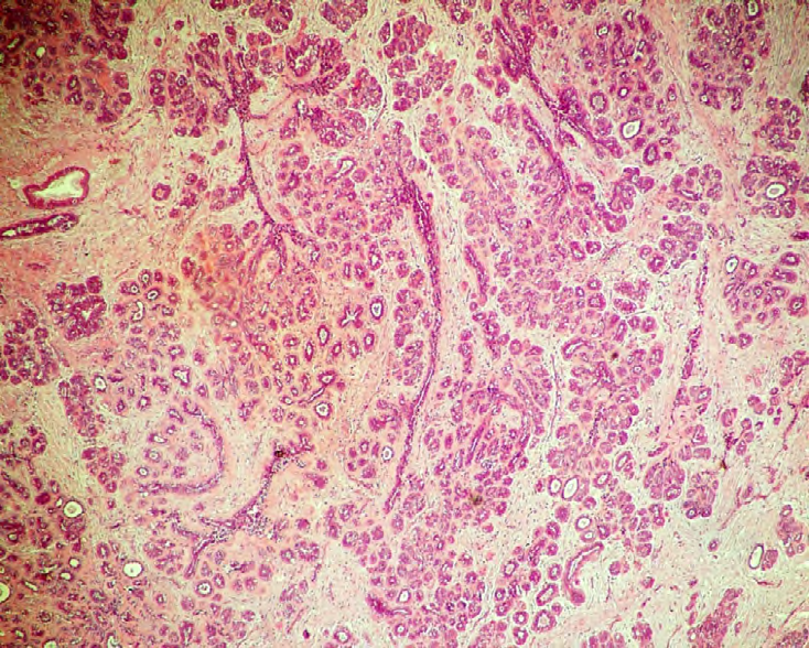 Figure 3: Sclerosing adenosis 10x (H&E).