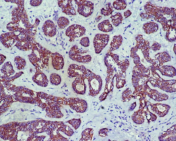 Figure 4: Sclerosing adenosis-P Cadherin positive (TS 8).