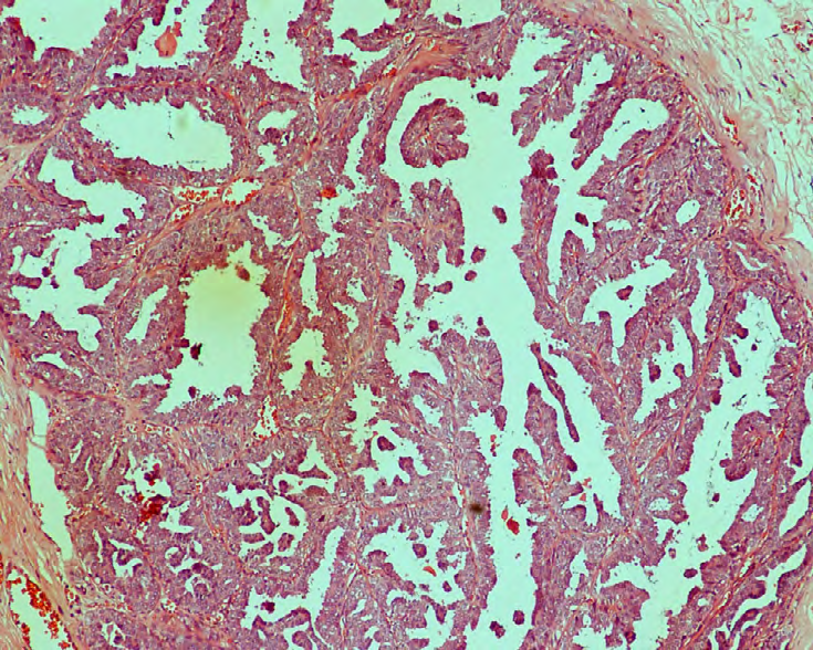Figure 5: Intraductal papilloma 10x (H&E).