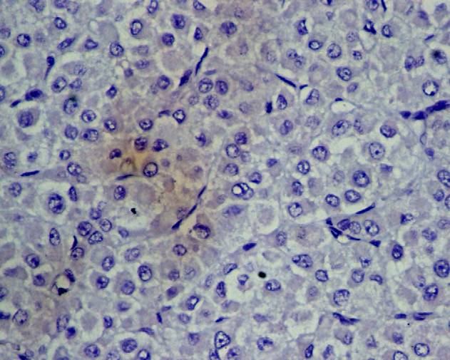 Figure 8: IDC- P cadherin Negative (TS 0).