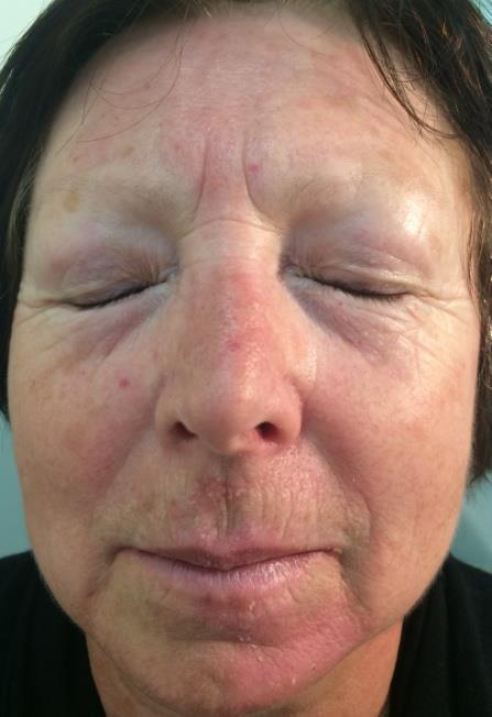 Figure 3: Patient K., 35 years, group I. Figure 4: Patient N., 64 years, group II. Diagnose: Rosacea, papulopustules subtype. Diagnose: Rosacea, erythematotelangiectatic subtype. Demodicosis. Mite load was 10 mites per 1 cm² in scraping.