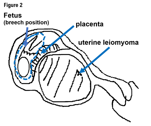 Figure 2: Positional relationship between uterine leiomyoma and placenta by the transabdominal ultrasound imaging.