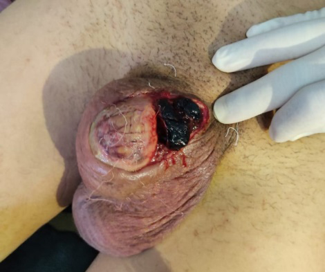 Figure 1: Severed penis replaced by a blood clot with amputation of part of the right hemi scrotum.