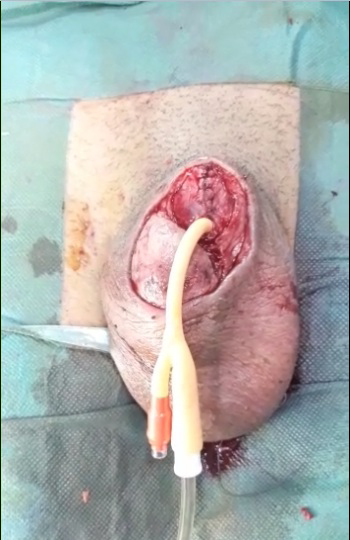Figure 2: After necrosectomy, washing and remodeling of the remaining penis with placement of a bladder catheter.