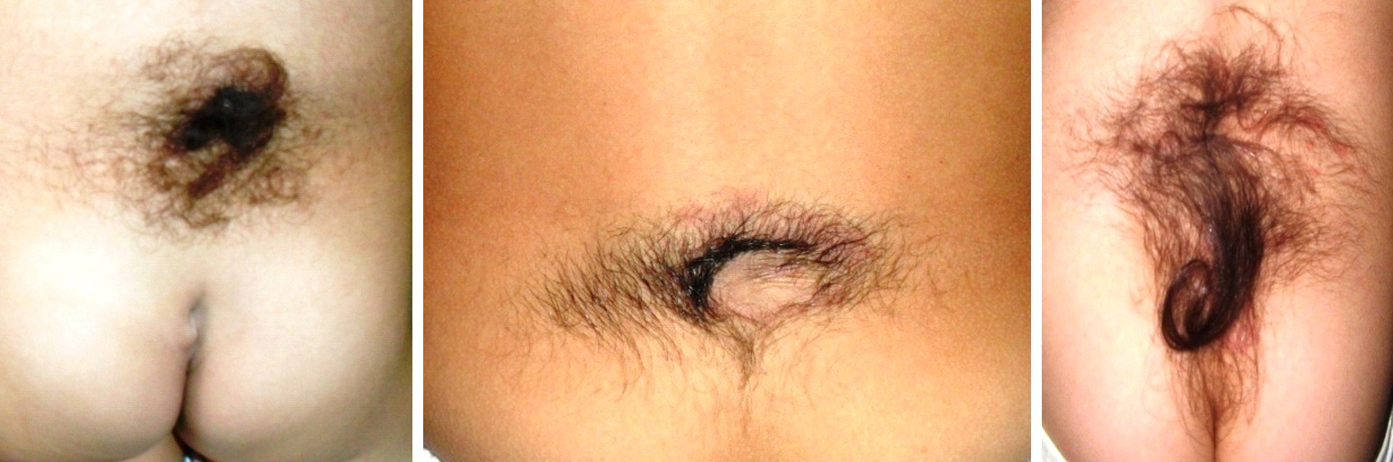 Figure 1: Skin stigmata.