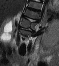 Figure 2: Radiological lesions: scoliosis on the left and vertebral block on the right.